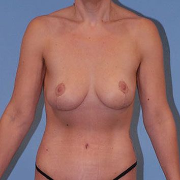 Breast Lift Before & After