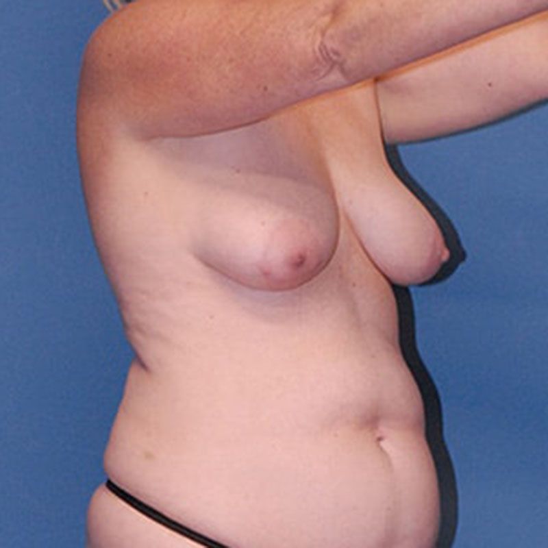 Breast Lift Before & After
