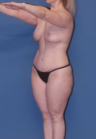 Breast Lift Before & After