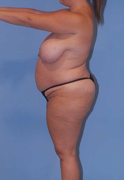 Breast Lift Before & After