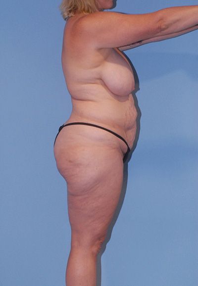 Breast Lift Before & After