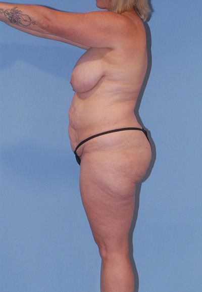 Breast Lift Before & After