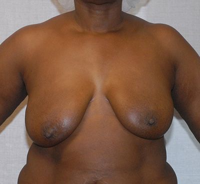 Breast Lift Before & After