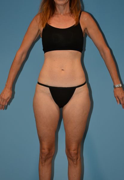 Body Lift Before & After