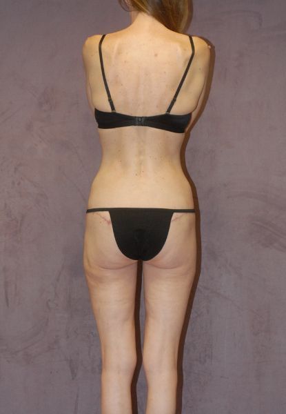 Body Lift Before & After