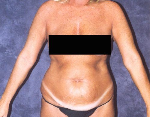 Body Lift Before & After