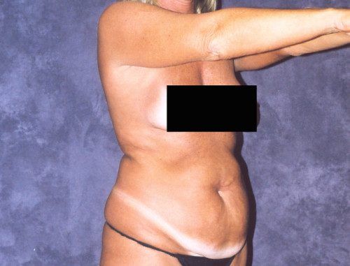 Body Lift Before & After