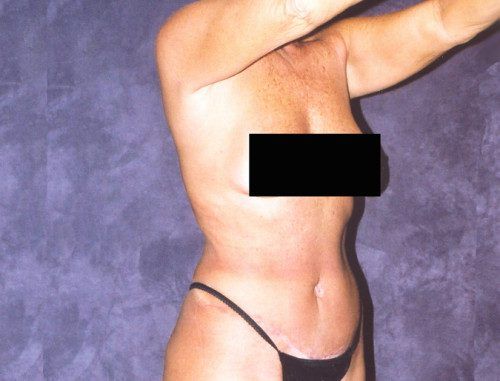 Body Lift Before & After