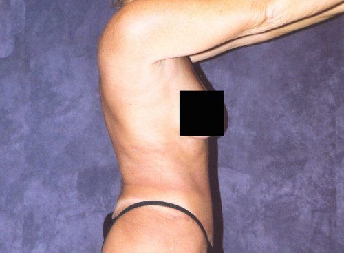 Body Lift Before & After