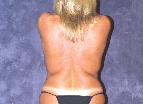 Body Lift Before & After