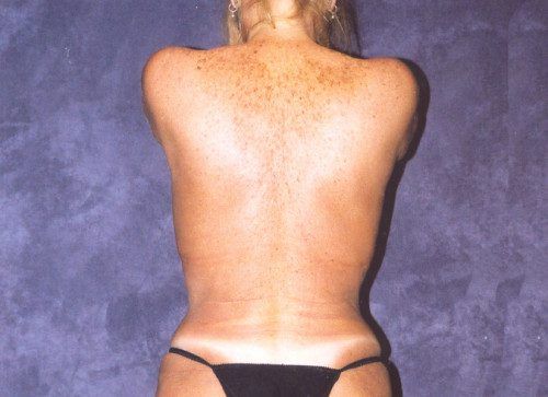 Body Lift Before & After