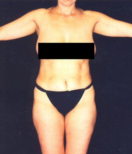 Body Lift Before & After