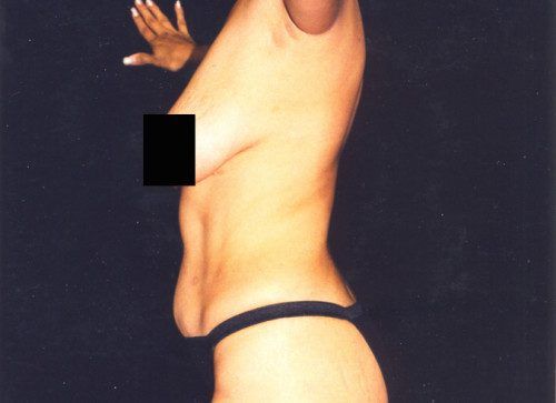 Body Lift Before & After