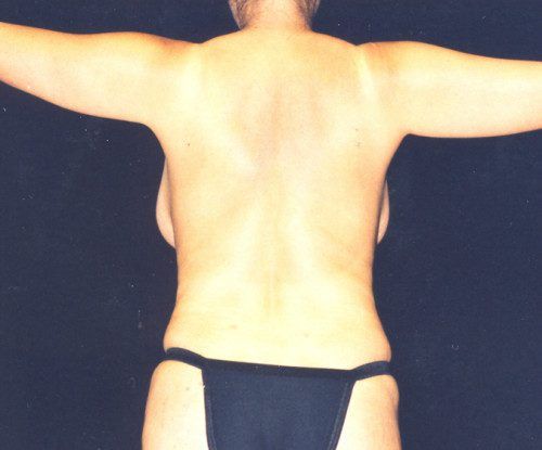 Body Lift Before & After