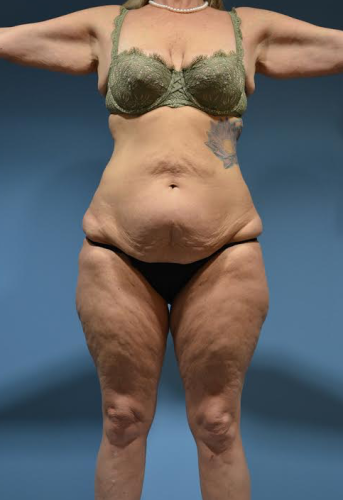 Body Lift Before & After