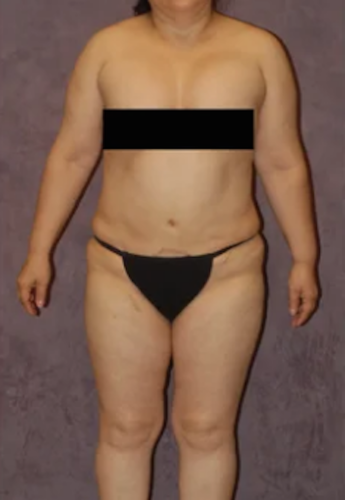 Body Lift Before & After