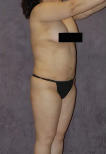Body Lift Before & After