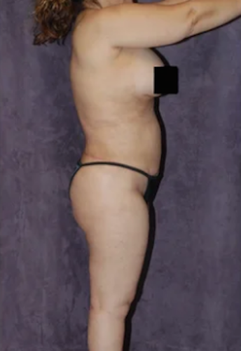 Body Lift Before & After