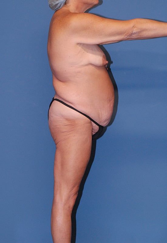 Body Lift Before & After