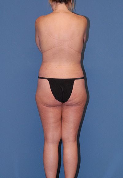 Body Lift Before & After