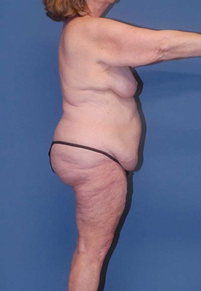 Body Lift Before & After