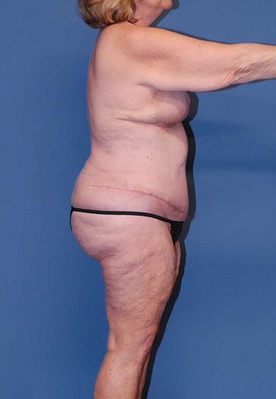 Body Lift Before & After