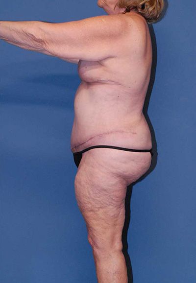 Body Lift Before & After