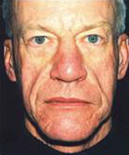 Male Facial Rejuvenation Before & After