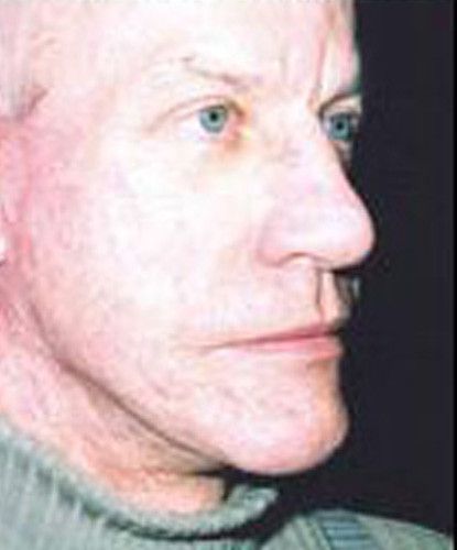 Male Facial Rejuvenation Before & After