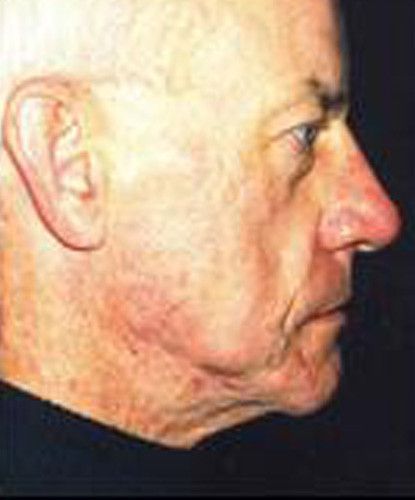 Male Facial Rejuvenation Before & After