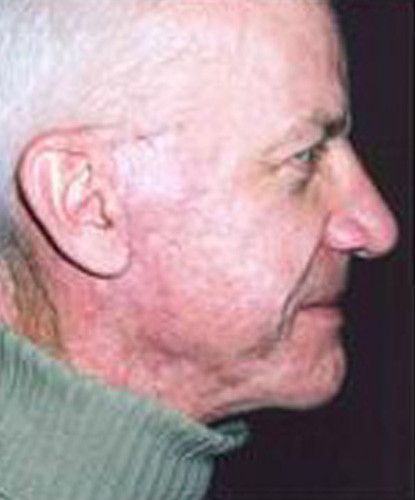 Male Facial Rejuvenation Before & After