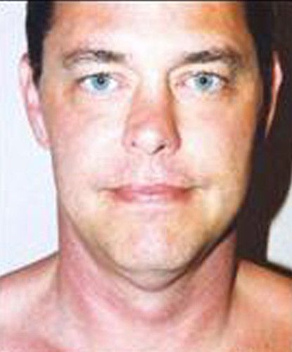 Male Facial Rejuvenation Before & After