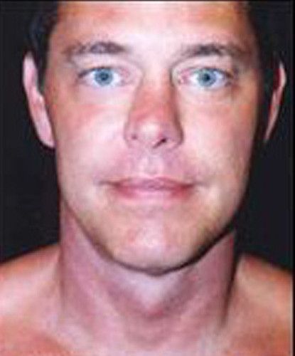 Male Facial Rejuvenation Before & After