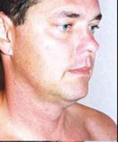 Male Facial Rejuvenation Before & After