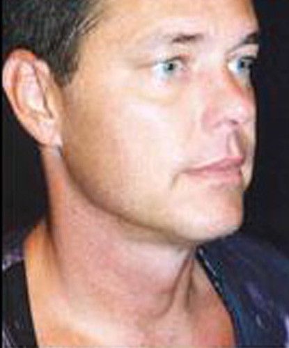 Male Facial Rejuvenation Before & After