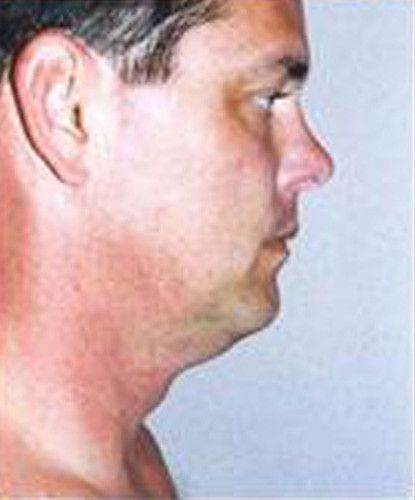 Male Facial Rejuvenation Before & After