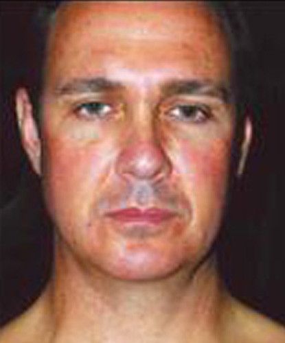 Male Facial Rejuvenation Before & After