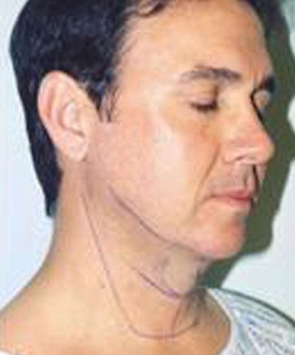 Male Facial Rejuvenation Before & After