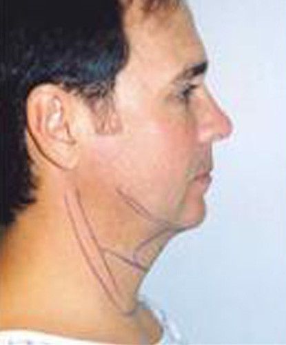 Male Facial Rejuvenation Before & After