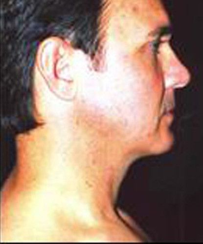 Male Facial Rejuvenation Before & After