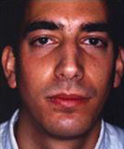 Male Facial Rejuvenation Before & After