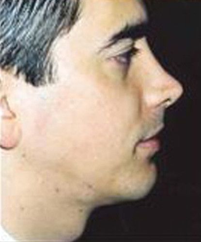 Male Facial Rejuvenation Before & After