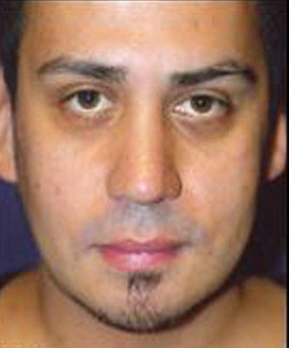 Male Facial Rejuvenation Before & After