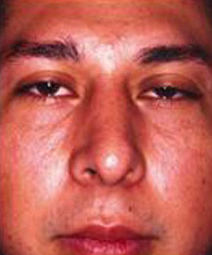 Male Facial Rejuvenation Before & After