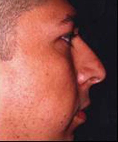 Male Facial Rejuvenation Before & After