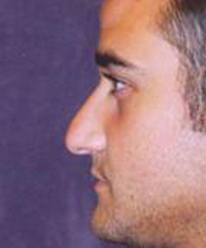 Male Facial Rejuvenation Before & After