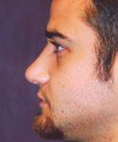 Male Facial Rejuvenation Before & After