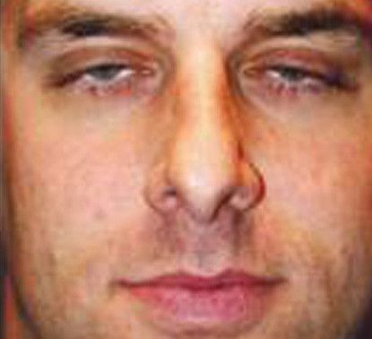 Male Facial Rejuvenation Before & After