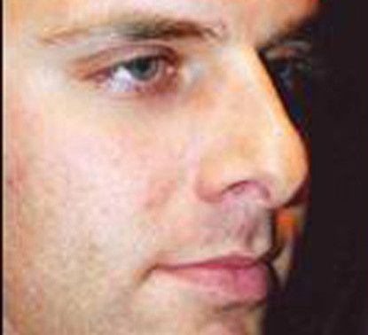 Male Facial Rejuvenation Before & After