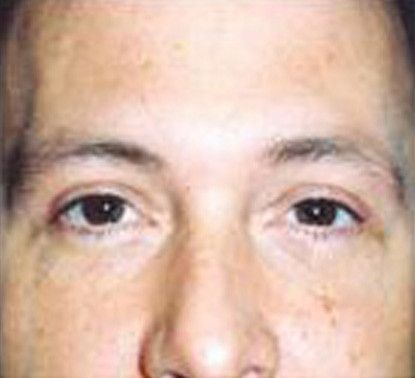 Male Facial Rejuvenation Before & After